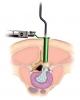 Medtronic METRx™ MicroDiscectomy System