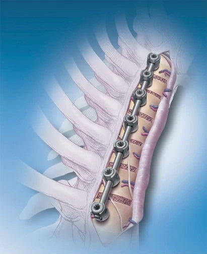 graphic of spine